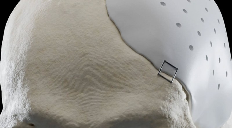 Massgefertigte Implantate für chirurgische Perfektion