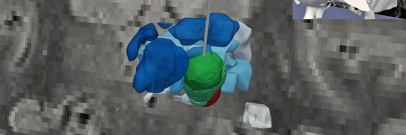 Parkinson Tiefenhirnstimulation.jpg