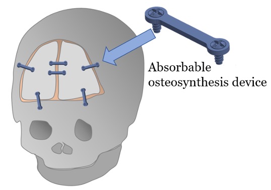Für die chirurgische Behandlung von Kraniosynostosen wurde eine resorbierbare Osteosynthese-Schrauben-Platten-Konstruktion aus der Mg-basierten Legierung «X0» mit optimierter Abbaukinetik und mechanischem Verhalten entwickelt.
