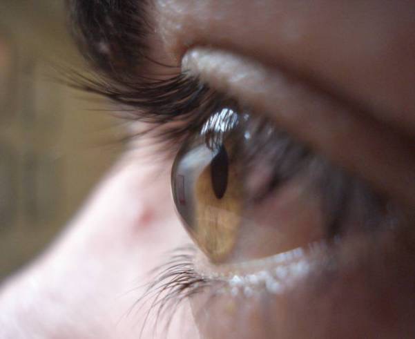 Kontaktlinsenversorgung bei irregulären Hornhautformen